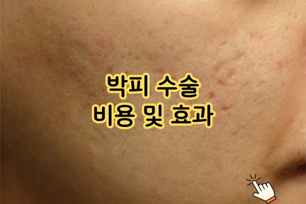 박피 수술 비용 및 효과