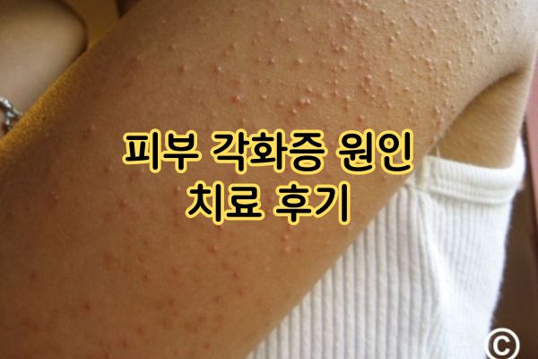 피부 각화증 원인 치료 후기