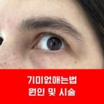 기미없애는법 원인 및 시술