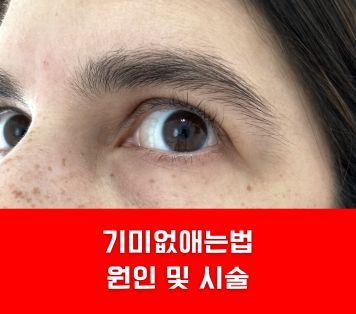 기미없애는법 원인 및 시술